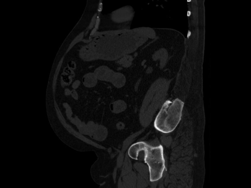 File:Ankylosing spondylitis (Radiopaedia 44609-48357 Sagittal bone window 75).jpg
