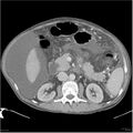 Annular pancreas and cirrhosis (Radiopaedia 24561-24843 A 9).jpg