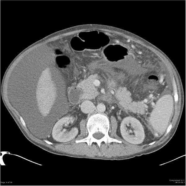 File:Annular pancreas and cirrhosis (Radiopaedia 24561-24843 A 9).jpg