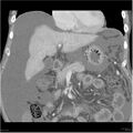 Annular pancreas and cirrhosis (Radiopaedia 24561-24843 B 4).jpg