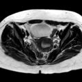 Ano-vaginal fistula (Radiopaedia 29765-30284 Axial T2 21).jpg