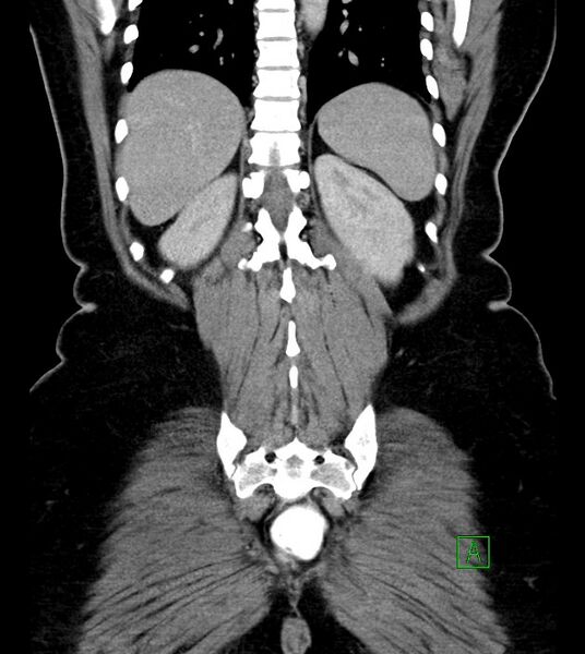 File:Anterior abdominal wall CSF pseudocyst (CSFoma) (Radiopaedia 79453-92571 B 44).jpg