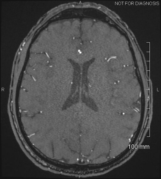 File:Anterior cerebral artery aneurysm (Radiopaedia 80683-94127 Axial MRA 153).jpg