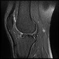 Anterior cruciate ligament tear with posteromedial corner injury, bucket-handle meniscal tear and chondral delamination (Radiopaedia 75501-86744 Sagittal PD fat sat 17).jpg