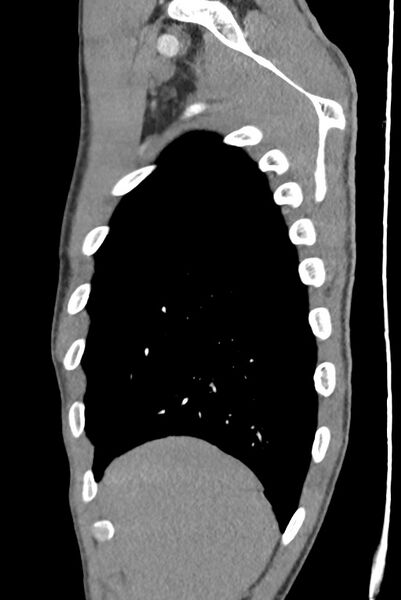 File:Aortic coarctation with aneurysm (Radiopaedia 74818-85828 B 29).jpg