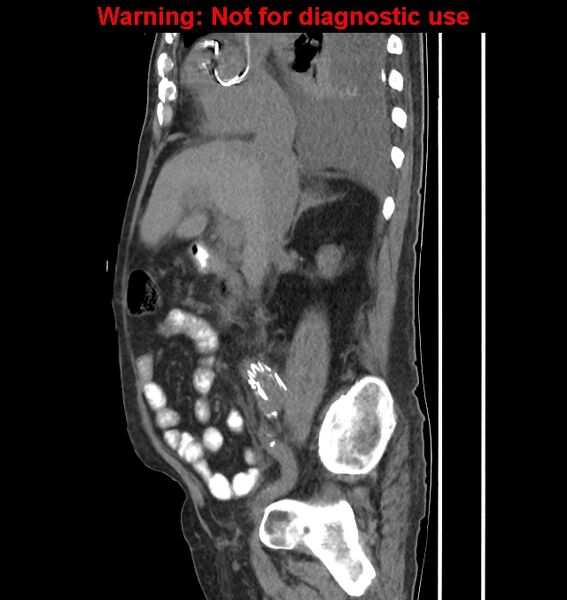 File:Aortic graft infection (Radiopaedia 44979-48907 C 44).jpg