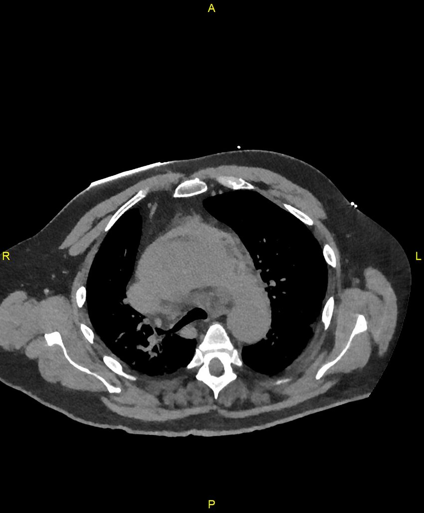 Aortic rupture (Radiopaedia 88822-105594 Axial non-contrast 69).jpg
