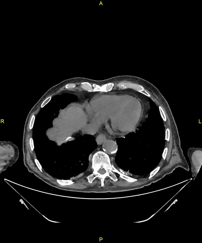 Aortoenteric fistula (Radiopaedia 84308-99603 Axial non-contrast 6).jpg