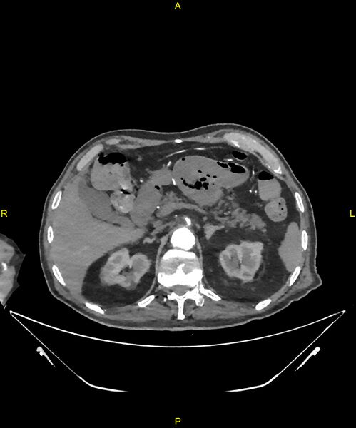 File:Aortoenteric fistula (Radiopaedia 84308-99603 B 85).jpg