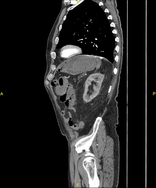 File:Aortoenteric fistula (Radiopaedia 84308-99603 C 263).jpg