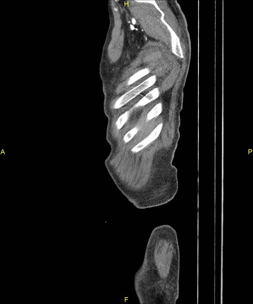 Aortoenteric fistula (Radiopaedia 84308-99603 C 326).jpg