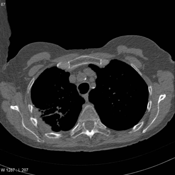 File:Apical non-small-cell lung cancer (Radiopaedia 8570-9405 Axial non-contrast 9).jpg