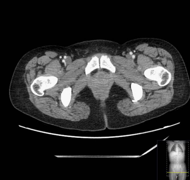 File:Appendicitis (CT angiogram) (Radiopaedia 154713-127660 Axial 90).jpg