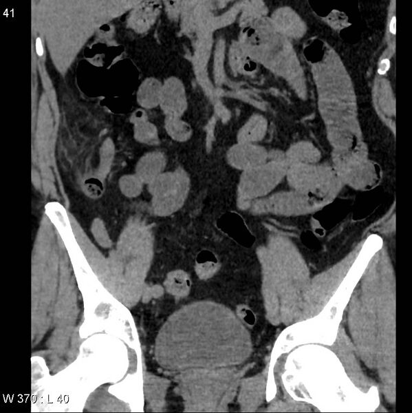 File:Appendicitis (Radiopaedia 12510-12733 Coronal non-contrast 11).jpg