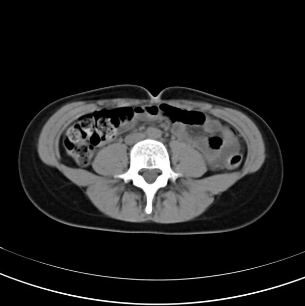 File:Appendicitis and incidental bicornuate uterus (Radiopaedia 22833-22853 Axial non-contrast 26).jpg