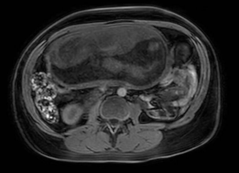 File:Appendicitis in gravida (MRI) (Radiopaedia 89433-106395 Axial DIXON 67).jpg