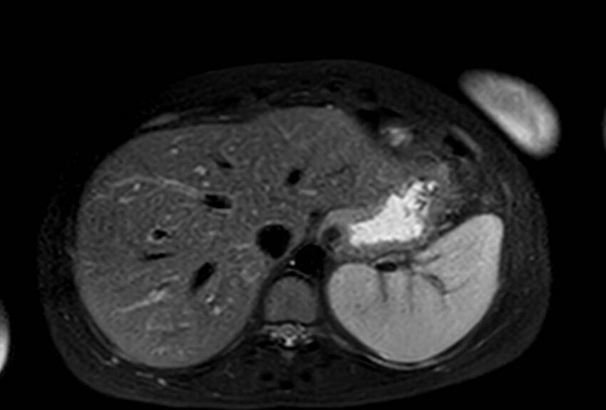 Appendicitis in gravida (MRI) (Radiopaedia 89433-106395 Axial T2 SPAIR 12).jpg