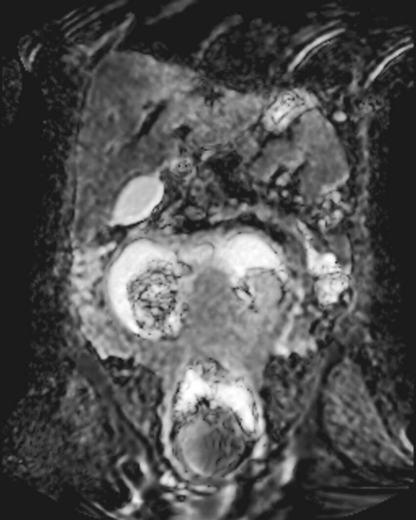 Appendicitis in gravida (MRI) (Radiopaedia 89433-106395 Coronal ADC 27).jpg