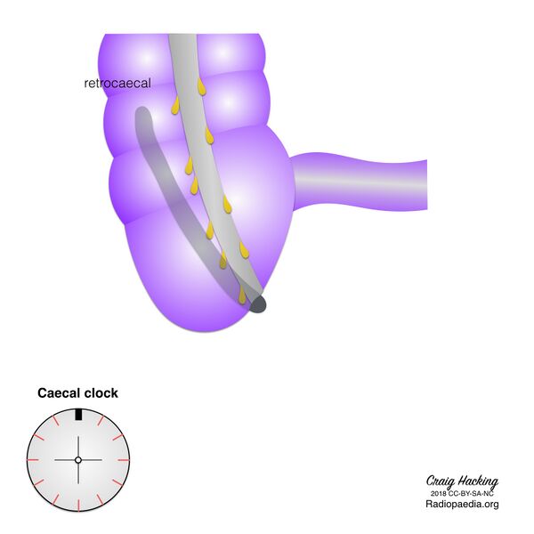 File:Appendix position (diagram) (Radiopaedia 62911-71293 C 1).jpeg