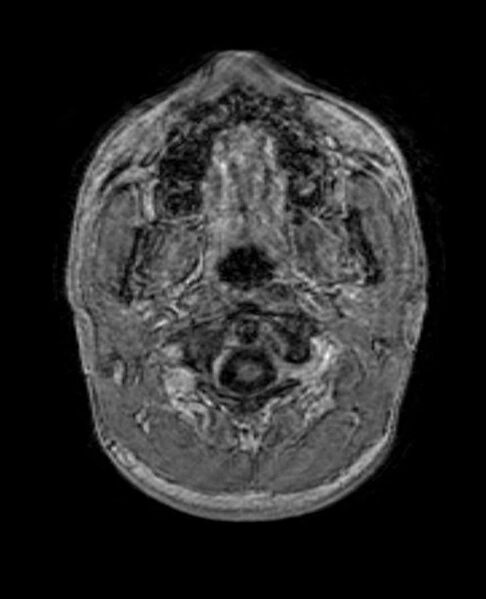 File:Arachnoid cyst- extremely large (Radiopaedia 68741-78451 Axial T1 C+ 4).jpg