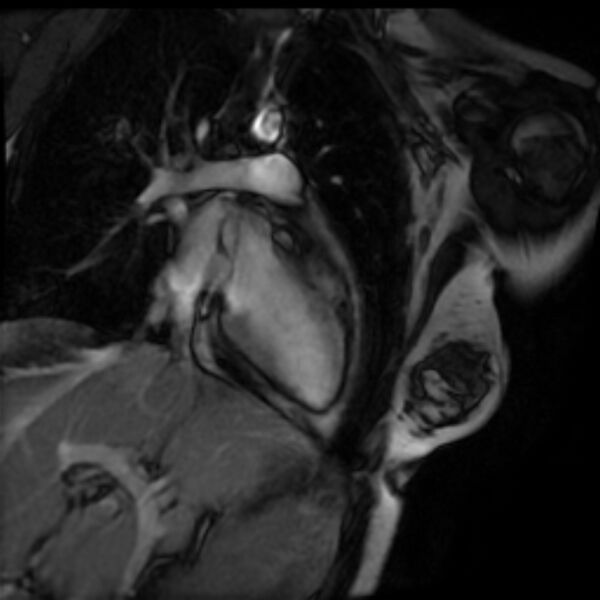 File:Arrhythmogenic right ventricular cardiomyopathy (Radiopaedia 87505-103850 2ch (LV) Cine SSFP 3).jpg