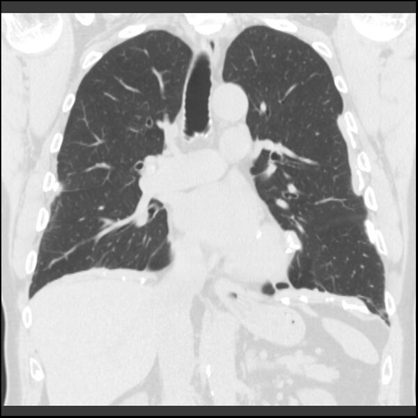 File:Asbestos-related pleural plaques (Radiopaedia 39069-41255 Coronal lung window 46).jpg