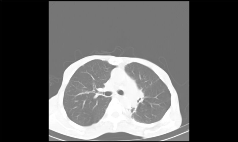 File:Aspergilloma (Radiopaedia 20788-20701 Axial lung window 14).jpg