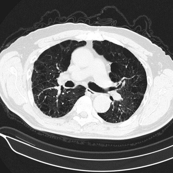 File:Aspergilloma (Radiopaedia 24521-24804 Axial lung window 8).jpg