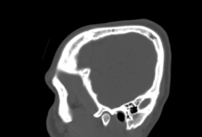 Asymptomatic occipital spur (Radiopaedia 87753-104201 Sagittal bone window 29).jpg