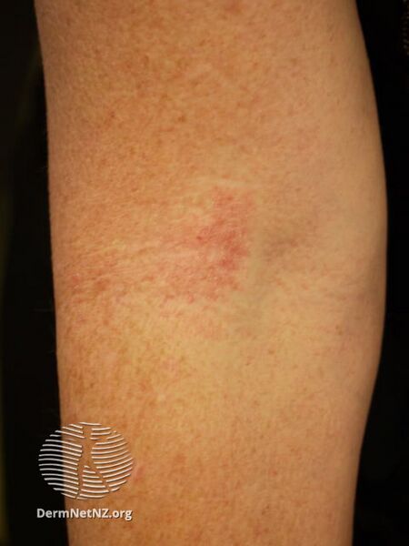 File:Atopic dermatitis (DermNet NZ dermatitis-flexural-eczema24).jpg