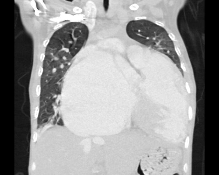 File:Atrial septal defect complicated by Eisenmenger syndrome (Radiopaedia 53707-59768 Sagittal lung window 10).jpg