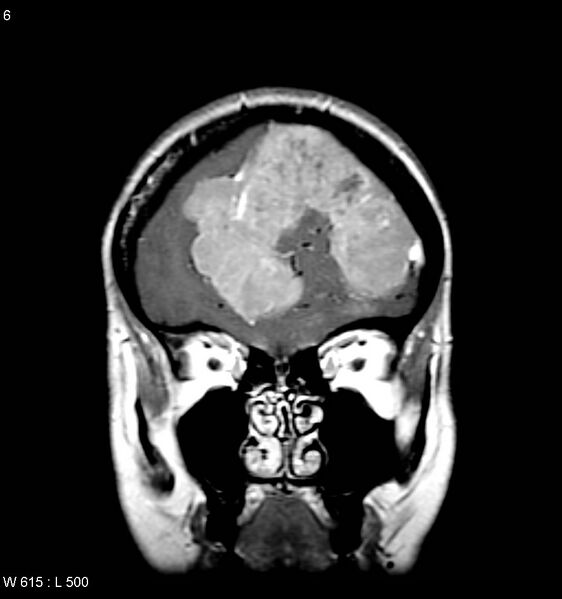 File:Atypical meningioma (WHO grade II) (Radiopaedia 7762-8586 Coronal T1 C+ 4).jpg