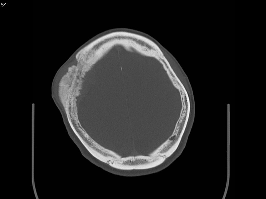 Atypical meningioma - intraosseous (Radiopaedia 64915-73867 Axial C+ bone window 54).jpg