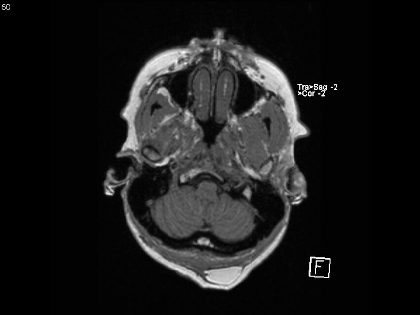 Atypical meningioma - intraosseous (Radiopaedia 64915-74572 Axial T1 60).jpg