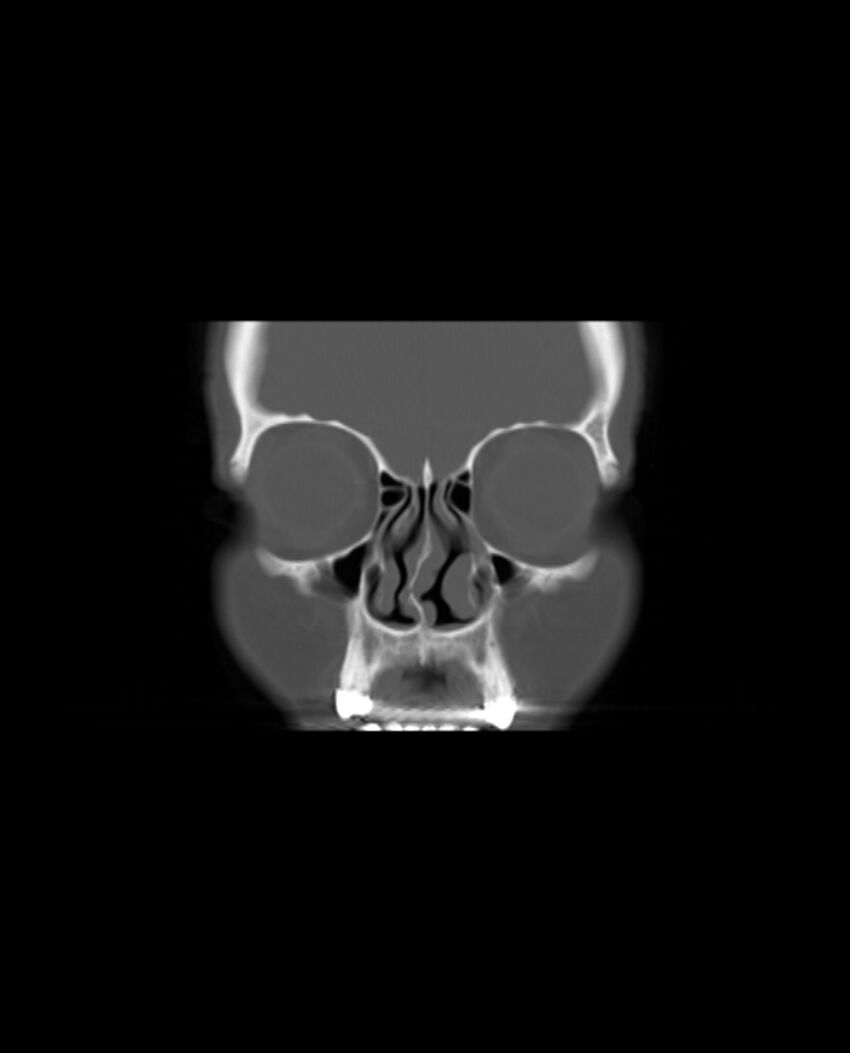 Automastoidectomy with labyrinthine fistula (Radiopaedia 84143-99411 Coronal non-contrast 16).jpg