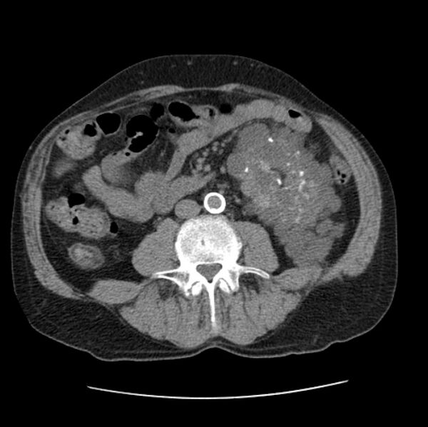 File:Autosomal dominant polycystic kidney disease (Radiopaedia 27851-28094 Axial non-contrast 79).jpg