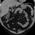 Autosomal dominant polycystic kidney disease (Radiopaedia 36539-38101 Coronal non-contrast 4).jpg