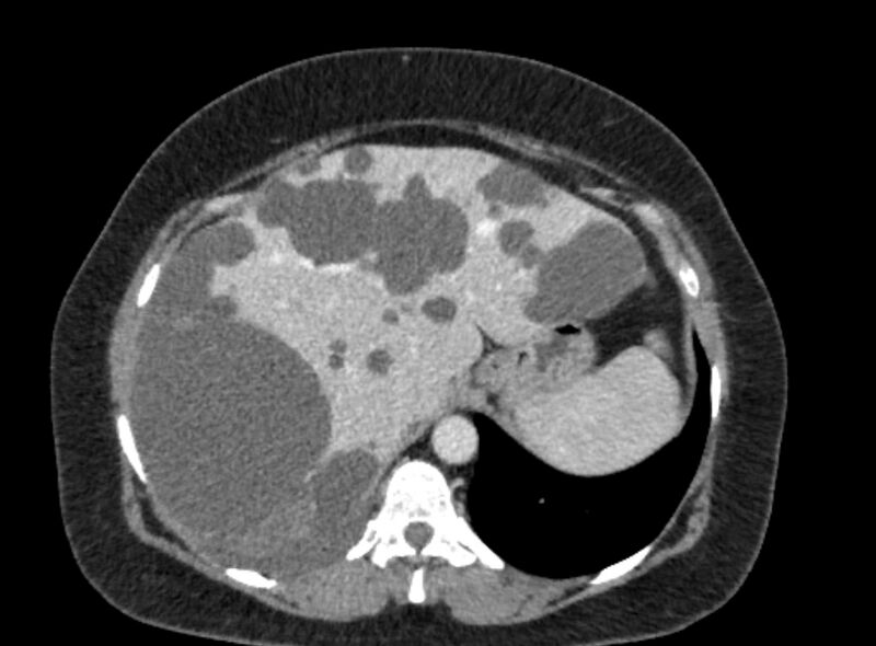 File:Autosomal dominant polycystic kidney disease (Radiopaedia 57124-64017 A 29).jpg