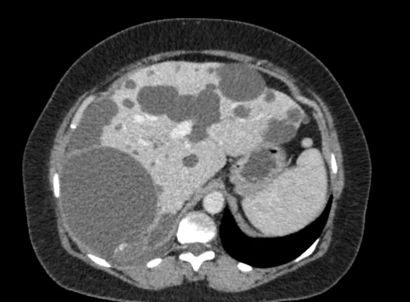 File:Autosomal dominant polycystic kidney disease (Radiopaedia 57124-64017 A 32).jpg