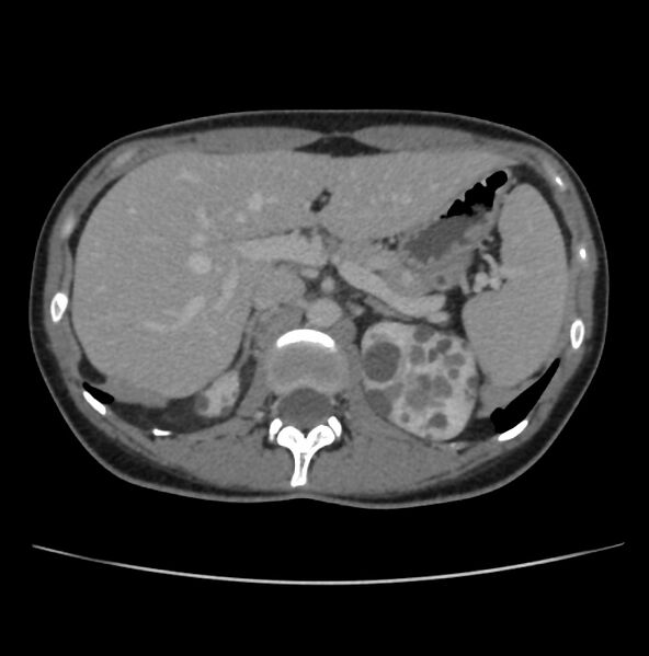 File:Autosomal dominant polycystic kidney disease - early onset (Radiopaedia 40734-43387 A 14).jpg