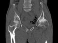 Avascular necrosis of the left hip (Radiopaedia 75068-86125 Coronal bone window 25).jpg