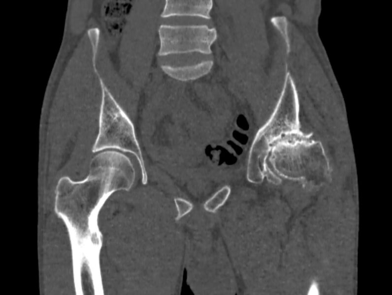File:Avascular necrosis of the left hip (Radiopaedia 75068-86125 Coronal bone window 25).jpg