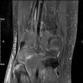Avulsion fracture of the fibular head (Radiopaedia 74804-85808 Coronal PD fat sat 29).jpg