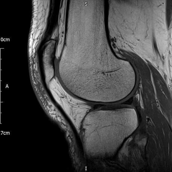 File:Avulsion fracture of the fibular head (Radiopaedia 74804-85808 D 23).jpg
