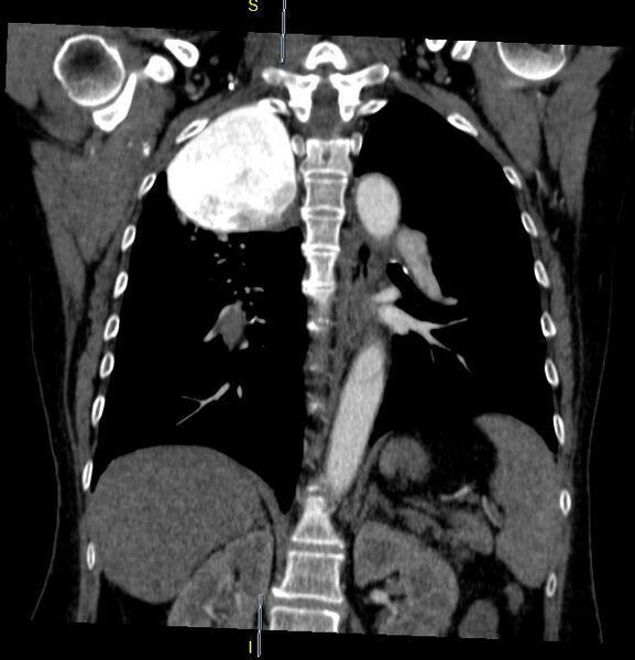 File:Azygos vein aneurysm (Radiopaedia 77824-90130 C 22).JPG