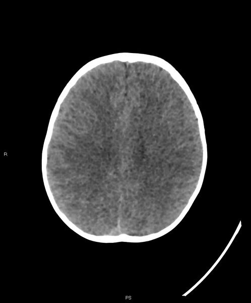 File:Basal ganglia and parenchymal ischemia (Radiopaedia 45818-50083 Axial non-contrast 15).jpg