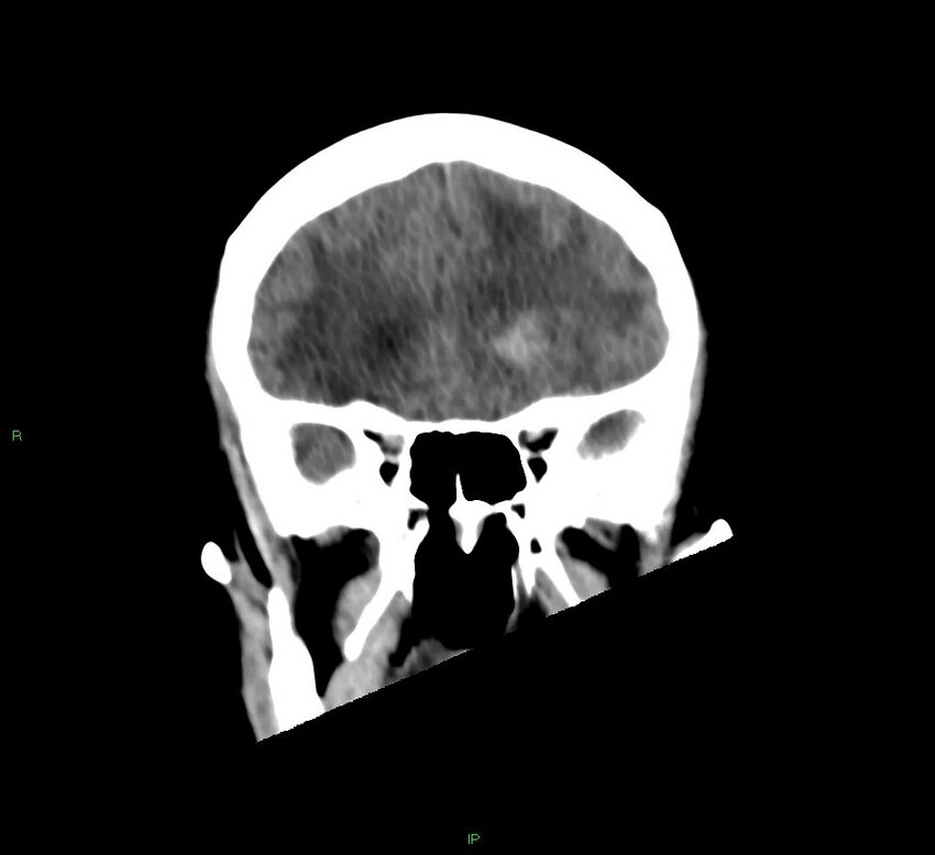 Basal ganglia hemorrhage (Radiopaedia 58766-65988 Coronal non-contrast 48).jpg