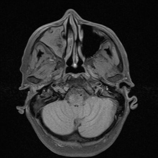 File:Base of skull chondrosarcoma (Radiopaedia 30410-31070 Axial T1 fat sat 5).jpg