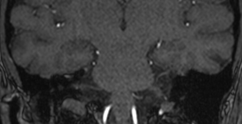 File:Basilar artery fenestration (Radiopaedia 74537-85455 Coronal MRA TOF 75).jpg