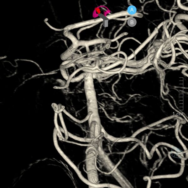 File:Basilar artery perforator aneurysm (Radiopaedia 82455-97734 3D view left VA 7).jpg